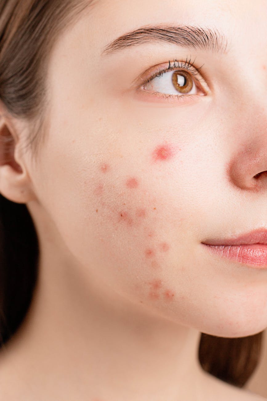 Acne: más allá de los granos – Una guía completa para entender y manejar tu piel